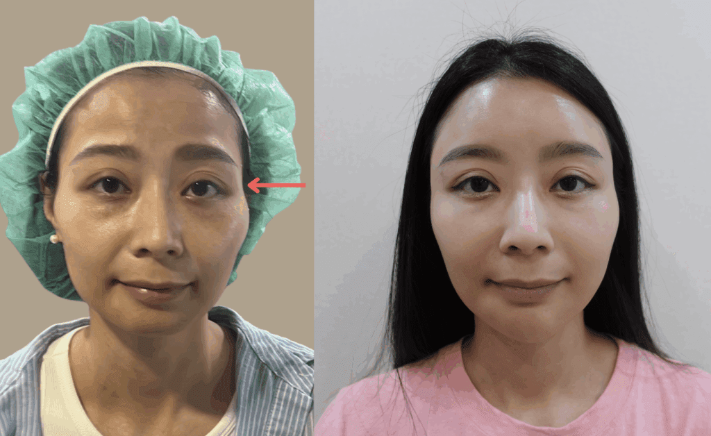 夫妻宮凹陷